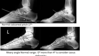 Normal calcaneal pitch 17°-
32°
Meary angle Normal range : 0° more than 4° is consider cavus
 