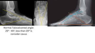 Normal Talocalcaneal angle:
25° - 45°, less than 20° is
consider cavus
 