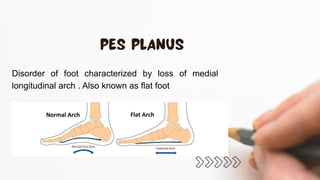 Disorder of foot characterized by loss of medial
longitudinal arch . Also known as flat foot
 