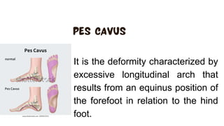 It is the deformity characterized by
excessive longitudinal arch that
results from an equinus position of
the forefoot in relation to the hind
foot.
 