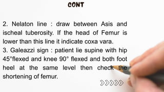 2. Nelaton line : draw between Asis and
ischeal tuberosity. If the head of Femur is
lower than this line it indicate coxa vara.
3. Galeazzi sign : patient lie supine with hip
45°flexed and knee 90° flexed and both foot
heel at the same level then check the
shortening of femur.
 