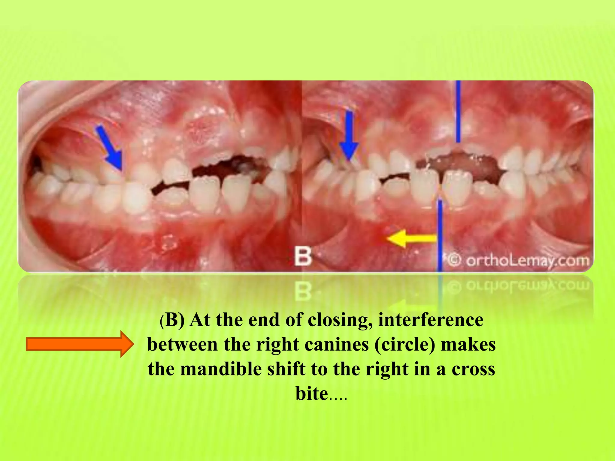 Mid Palatal Injection HOW to measure CBCT BEFORE AND AFTER MID PALATAL SUTURE OPENING | PPTX