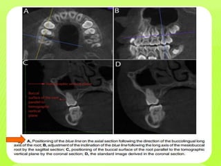Mid Palatal Injection HOW to measure CBCT BEFORE AND AFTER MID PALATAL SUTURE OPENING | PPTX