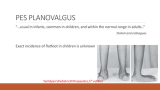 “…usual in infants, common in children, and within the normal range in adults..”
Staheli and colleagues
Exact incidence of flatfoot in children is unknown
PES PLANOVALGUS
Tachdjian’sPediatricOrthopaedics,5th edition
 