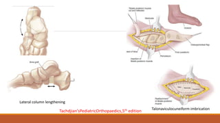 Lateral column lengthening
Talonaviculocuneiform imbrication
Tachdjian’sPediatricOrthopaedics,5th edition
 
