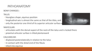 PATHOANATOMY
BONY CHANGES :
TALUS:
◦ hourglass shape ,equinus position
◦ longitudinal axis is almost the same as that of the tibia, and
◦ only the posterior one third of its superior articular surface articulates with the tibia.
NAVICULAR:
◦ articulates with the dorsal aspect of the neck of the talus and is locked there
◦ proximal articular surface is tilted plantarward
CALCANEUM:
◦ displaced posterolaterally in relation to the talus
◦ in contact with the distal end of the fibula
◦ tilted into equinus
 