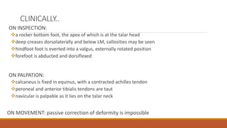 CLINICALLY..
ON INSPECTION:
a rocker bottom foot, the apex of which is at the talar head
deep creases dorsolaterally and below LM, callosities may be seen
hindfoot foot is everted into a valgus, externally rotated position
forefoot is abducted and dorsiflexed
ON PALPATION:
calcaneus is fixed in equinus, with a contracted achilles tendon
peroneal and anterior tibialis tendons are taut
navicular is palpable as it lies on the talar neck
ON MOVEMENT: passive correction of deformity is impossible
 