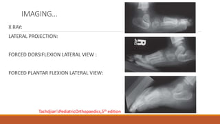 IMAGING…
X RAY:
LATERAL PROJECTION:
FORCED DORSIFLEXION LATERAL VIEW :
FORCED PLANTAR FLEXION LATERAL VIEW:
Tachdjian’sPediatricOrthopaedics,5th edition
 