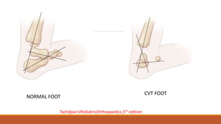 NORMAL FOOT
CVT FOOT
Tachdjian’sPediatricOrthopaedics,5th edition
 