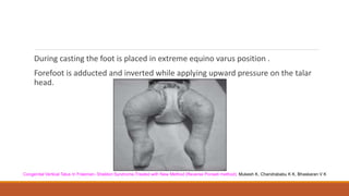 During casting the foot is placed in extreme equino varus position .
Forefoot is adducted and inverted while applying upward pressure on the talar
head.
Congenital Vertical Talus In Freeman- Sheldon Syndrome.Treated with New Method (Reverse Ponseti method). Mukesh K, Chandrababu K K, Bhaskaran V K
 