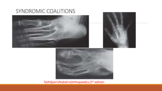 SYNDROMIC COALITIONS
Tachdjian’sPediatricOrthopaedics,5th edition
 