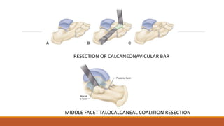 RESECTION OF CALCANEONAVICULAR BAR
MIDDLE FACET TALOCALCANEAL COALITION RESECTION
 