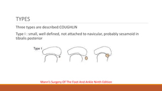 TYPES
Three types are described:COUGHLIN
Type I : small, well defined, not attached to navicular, probably sesamoid in
tibialis posterior
Mann’s Surgery Of The Foot And Ankle Ninth Edition
 
