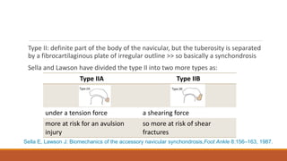 Type II: definite part of the body of the navicular, but the tuberosity is separated
by a fibrocartilaginous plate of irregular outline >> so basically a synchondrosis
Sella and Lawson have divided the type II into two more types as:
Type IIA Type IIB
under a tension force a shearing force
more at risk for an avulsion
injury
so more at risk of shear
fractures
Sella E, Lawson J: Biomechanics of the accessory navicular synchondrosis,Foot Ankle 8:156–163, 1987.
 