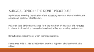SURGICAL OPTION : THE KIDNER PROCEDURE
A procedure involving the excision of the accessory navicular with or without the
plication of posterior tibial tendon.
Posterior tibial tendon is detached from the insertion on navicular and rerouted
in plantar to dorsal direction and sutured on itself or surrounding periosteum.
Rerouting is necessary only when there is pes planus.
Sometimes medial slide osteotomy of proximal fragment of calcaneum is also
added.
 
