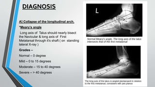 DIAGNOSIS
A] Collapse of the longitudinal arch.
*Meary’s angle
Long axis of Talus should nearly bisect
the Navicular & long axis of First
Metatarsal through it’s shaft ( on standing
lateral X-ray )
Grades –
Normal – 0 degree
Mild – 0 to 15 degrees
Moderate – 15 to 40 degrees
Severe – > 40 degrees
 