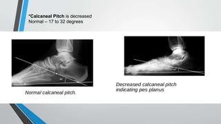 *Calcaneal Pitch is decreased
Normal – 17 to 32 degrees
 