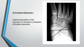 C] Forefoot Abduction :
Lateral subluxation of the
navicular on the talus is indication
of forefoot abduction
 