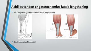 Achilles tendon or gastrocnemius fascia lengthening
• TA Lengthening – Percutaneous & Z lengthening
• Gastrocnemius Recession
 