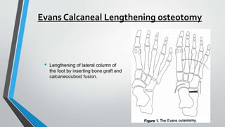 Evans Calcaneal Lengthening osteotomy
• Lengthening of lateral column of
the foot by inserting bone graft and
calcaneocuboid fusion.
 