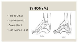pes planus and pes clavus ppt_083125.pptx