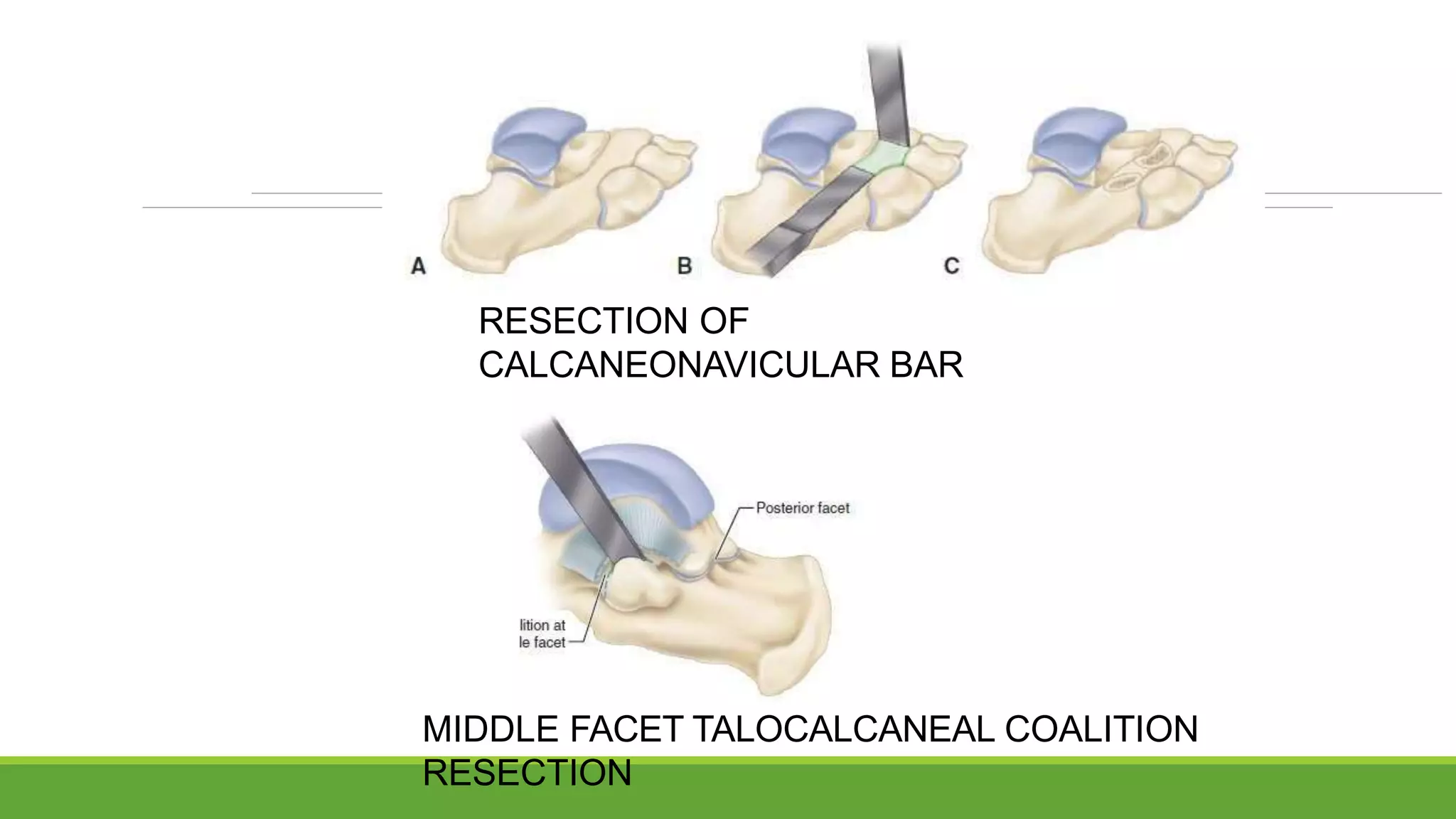 Bar Resection Pes planus and pes valgus | PPTX