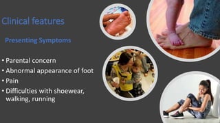 Clinical features
Presenting Symptoms
• Parental concern
• Abnormal appearance of foot
• Pain
• Difficulties with shoewear,
walking, running
 