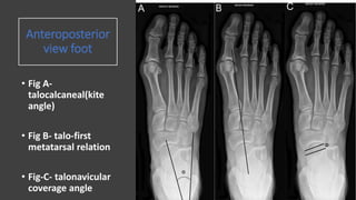 Anteroposterior
view foot
• Fig A-
talocalcaneal(kite
angle)
• Fig B- talo-first
metatarsal relation
• Fig-C- talonavicular
coverage angle
 