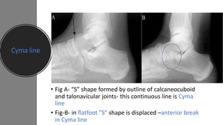 Cyma line
• Fig A- “S” shape formed by outline of calcaneocuboid
and talonavicular joints- this continuous line is Cyma
line
• Fig-B- in flatfoot ”S” shape is displaced –anterior break
in Cyma line
 
