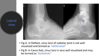 Lateral
view
• Fig A- In flatfoot, sinus tarsi of subtalar joint is not well
visualized and termed as “obliterated”
• Fig B- In Cavus foot, sinus tarsi is very well visualized and may
be termed as “bullethole”
 
