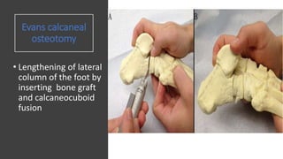 Evans calcaneal
osteotomy
• Lengthening of lateral
column of the foot by
inserting bone graft
and calcaneocuboid
fusion
 