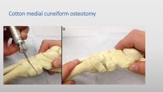 Cotton medial cuneiform osteotomy
 