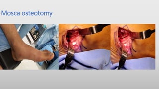 Mosca osteotomy
 
