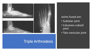 Triple Arthrodesis
Joints fused are:
• Subtalar joint
• Calcaneo cuboid
joint
• Talo navicular joint
 