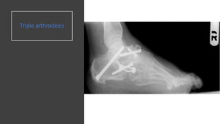 Triple arthrodesis
 
