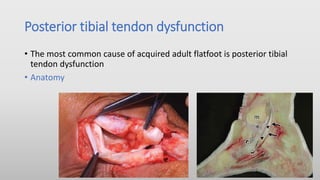Posterior tibial tendon dysfunction
• The most common cause of acquired adult flatfoot is posterior tibial
tendon dysfunction
• Anatomy
 