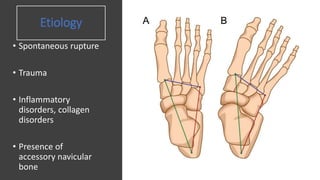 Etiology
• Spontaneous rupture
• Trauma
• Inflammatory
disorders, collagen
disorders
• Presence of
accessory navicular
bone
 