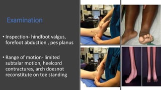 Examination
• Inspection- hindfoot valgus,
forefoot abduction , pes planus
• Range of motion- limited
subtalar motion, heelcord
contractures, arch doesnot
reconstitute on toe standing
 