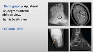 •Radiography- Ap,lateral
45 degrees internal
oblique view,
harris beath view
•CT scan , MRI
 