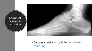 Calcaneal-
navicular
coalition
• Calcanealnavicular coalition – anteater
nose sign
 