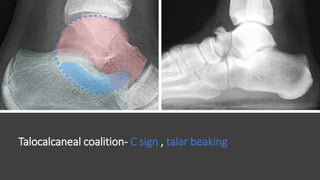 Talocalcaneal coalition- C sign , talar beaking
 