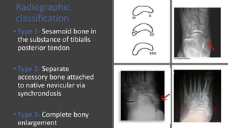 Radiographic
classification
• Type 1- Sesamoid bone in
the substance of tibialis
posterior tendon
• Type 2- Separate
accessory bone attached
to native navicular via
synchrondosis
• Type 3- Complete bony
enlargement
 