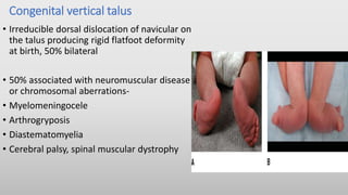 Congenital vertical talus
• Irreducible dorsal dislocation of navicular on
the talus producing rigid flatfoot deformity
at birth, 50% bilateral
• 50% associated with neuromuscular disease
or chromosomal aberrations-
• Myelomeningocele
• Arthrogryposis
• Diastematomyelia
• Cerebral palsy, spinal muscular dystrophy
 