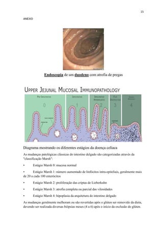 15
ANEXO
Endoscopia de um duodeno com atrofia de pregas
Diagrama mostrando os diferentes estágios da doença celíaca
As mudanças patológicas clássicas do intestino delgado são categorizadas através da
"classificação Marsh":
• Estágio Marsh 0: mucosa normal
• Estágio Marsh 1: número aumentado de linfócitos intra-epiteliais, geralmente mais
de 20 a cada 100 enterócitos
• Estágio Marsh 2: proliferação das criptas de Lieberkuhn
• Estágio Marsh 3: atrofia completa ou parcial das vilosidades
• Estágio Marsh 4: hipoplasia da arquitetura do intestino delgado
As mudanças geralmente melhoram ou são revertidas após o glúten ser removido da dieta,
devendo ser realizada diversas biópsias meses (4 a 6) após o início da exclusão do glúten.
 