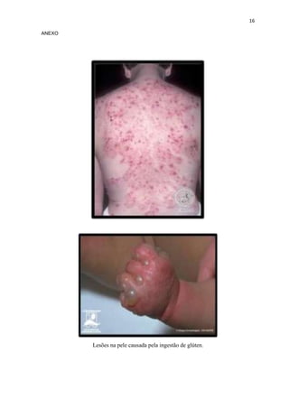 16
ANEXO
Lesões na pele causada pela ingestão de glúten.
 