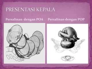 Persalinan dengan POA Persalinan dengan POP
 