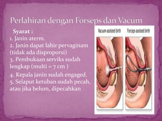 1.Syarat :
1. Janin aterm.
2. Janin dapat lahir pervaginam
(tidak ada disproporsi)
3. Pembukaan serviks sudah
lengkap (multi = 7 cm )
4. Kepala janin sudah engaged.
5. Selaput ketuban sudah pecah,
atau jika belum, dipecahkan
 