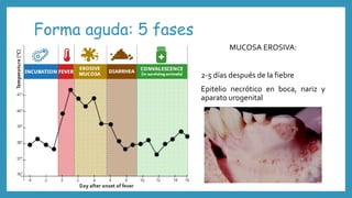 Forma aguda: 5 fases
MUCOSA EROSIVA:
2-5 días después de la fiebre
Epitelio necrótico en boca, nariz y
aparato urogenital
 