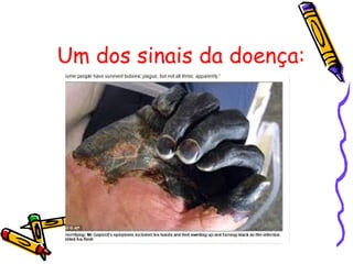 Um dos sinais da doença:
 