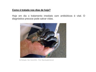 Como é tratada nos dias de hoje?
Hoje em dia o tratamento imediato com antibióticos é vital. O
diagnóstico precoce pode salvar vidas.
Da Redação: Alan Vianni/UOL - Foto: Reprodução/internet
 